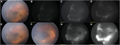 Two-step widefield fundus fluorescein angiography-assisted laser photocoagulation in pediatric retinal vasculopathy: A pilot study